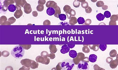 Acute Lymphoblastic Leukemia (ALL) .